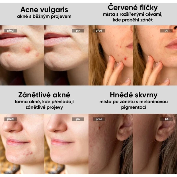 JOVS Acneaway přístroj na léčbu akné - Čističe pleti - Obrázek 78a5187bff134fa0a149d0d73902c31f