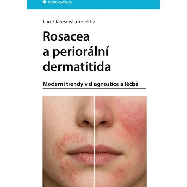 Rosacea a periorální dermatitida - Smarty.cz