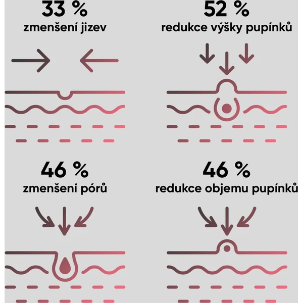 JOVS Acneaway přístroj na léčbu akné - Čističe pleti - Obrázek da819e1fc3334f1690443e3171802840