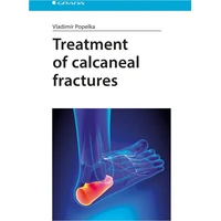 Treatment of calcaneal fractures - E-kniha